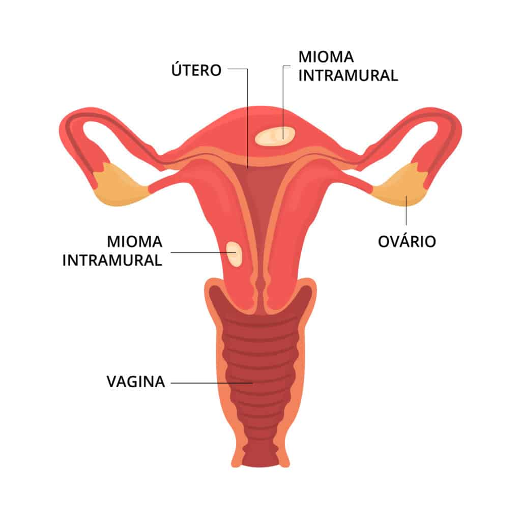 Miomas Uterinos Dr Mario Ramin